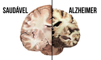 alzheimer cerebro