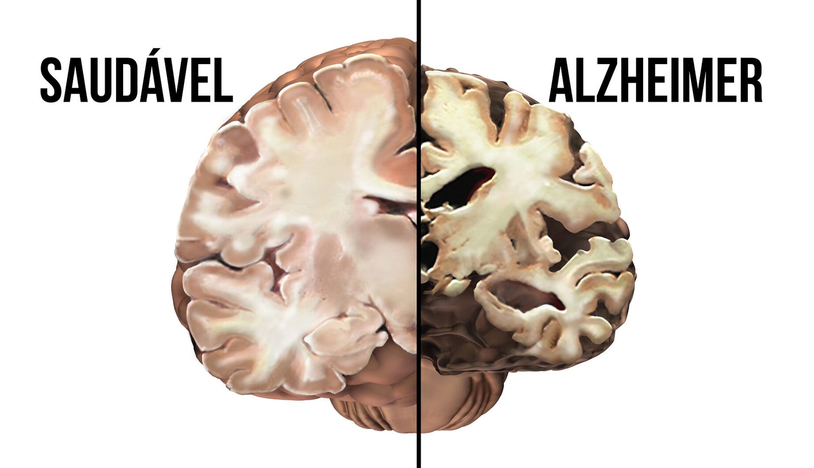 alzheimer cerebro